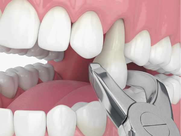 마곡역치과_&ldquo;괜찮겠지 했다가 더 커집니다&rdquo;[4. 금간 치아 방치 시 발생하는 문제] 관련 이미지 2