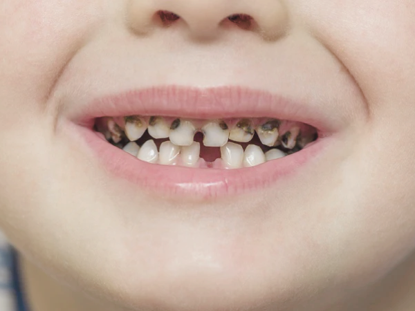 마곡역치과_2. 유치기 어린이(4~7세) 충치 예방, 부모가 꼭 알아야 할 구강 관리법 관련 이미지 3