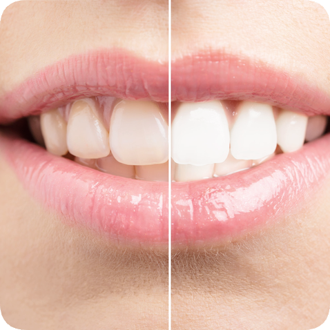 마곡동치과_전문가 미백 관련 이미지 7