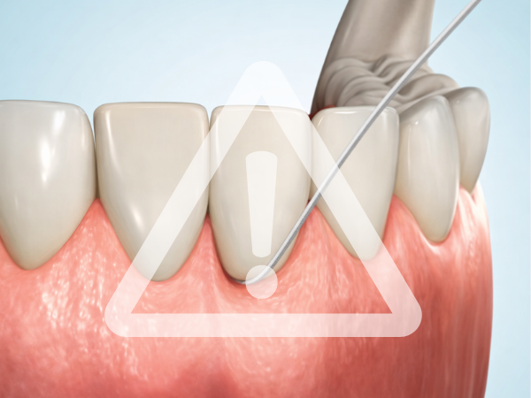 마곡역치과_4. 브릿지 치료 단점과 수명, 얼마나 오래 사용할 수 있을까요? 관련 이미지 2