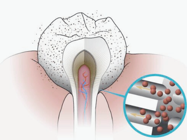 마곡치과_"삭제없이 환하게" [1. 치아 미백치료 원리] 관련 이미지 3