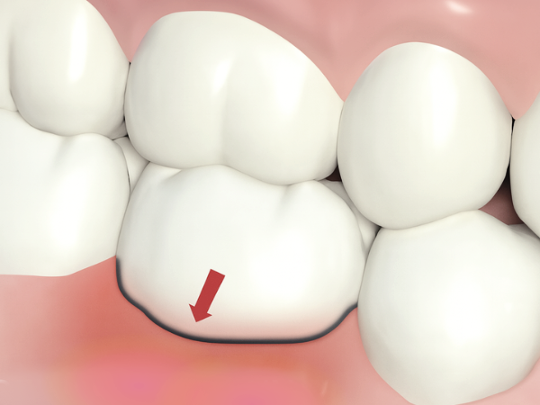 Magaok Station Dental Clinic_ “Why Do Gums Recede?” [1. Causes of Gingival Recession] image 8