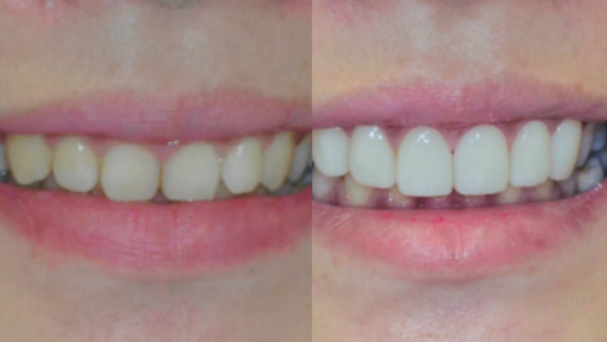 마곡동치과_2. 무삭제 라미네이트가 불가능한 경우 관련 이미지 5