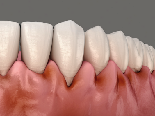 Maggok Dental_1. “If Your Gums Bleed When You Brush Your Teeth?” Early Symptoms of Gingivitis and Self-Check Method image 1