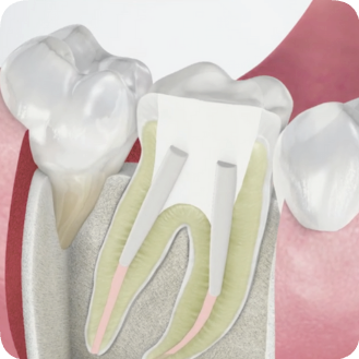마곡치과_"이럴 땐 레진이 답입니다" [ 1. 치과 레진 활용법 ] 관련 이미지 3