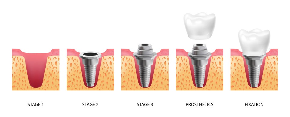 [ Magok Implants_09 ] Does a Loose Implant Always Require Revision Surgery? image 1