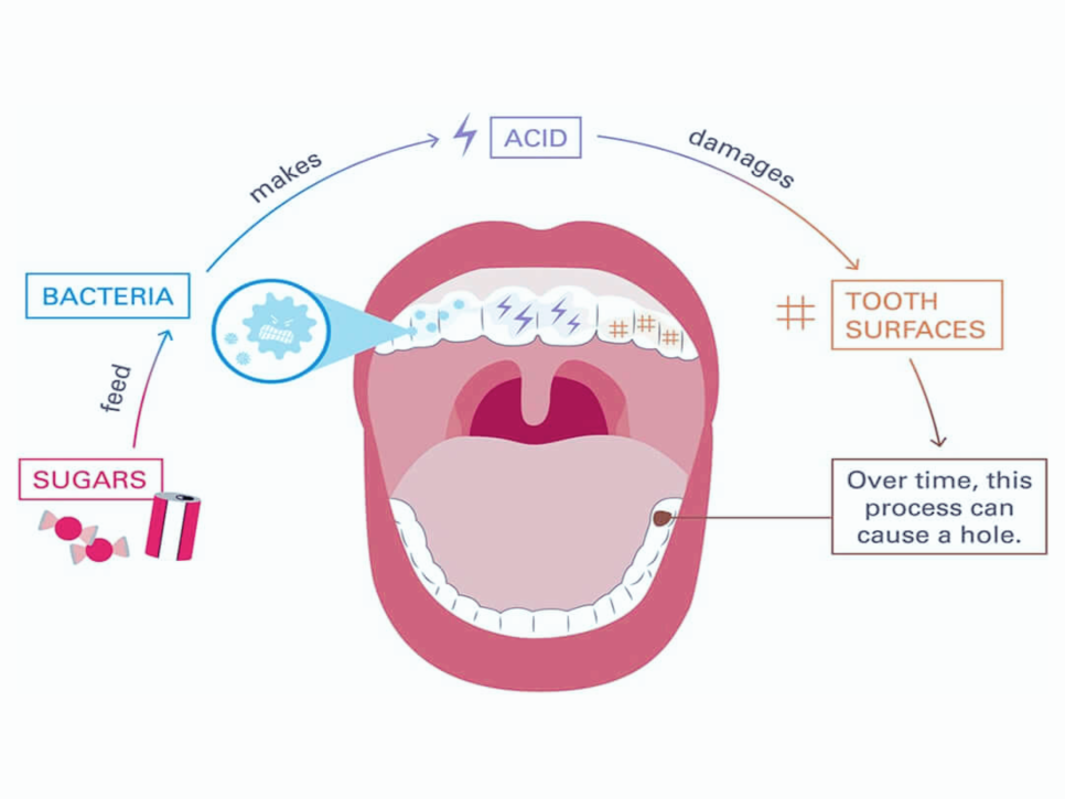 마곡동치과_ &ldquo;아무도 모르게, 아주 조용히&rdquo; [1. 충치가 생기는 과정 ] 관련 이미지 4