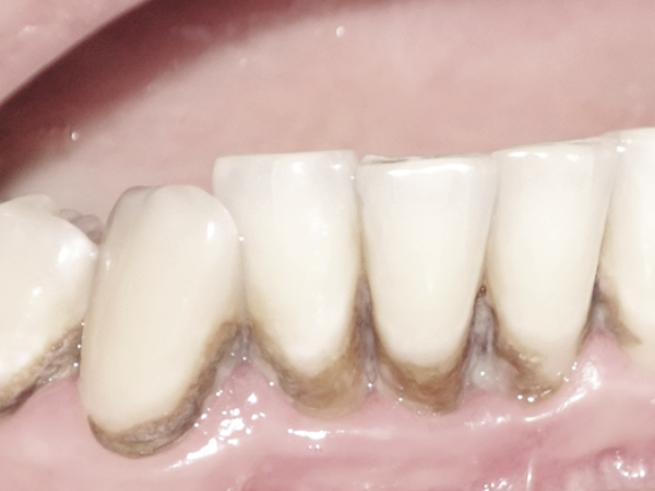 Maggok Dental_1. “If Your Gums Bleed When You Brush Your Teeth?” Early Symptoms of Gingivitis and Self-Check Method image 2