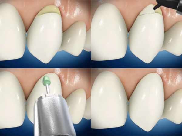 마곡역치과_&ldquo;이가 닳았다면 이렇게 해결하세요!&rdquo; [5. 치아마모 치료] 관련 이미지 2