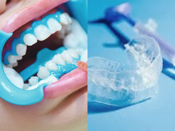 마곡역치과_&ldquo;하얗게 만들었으면 지켜줘야죠!&rdquo;[5. 치아미백 후 주의사항] 관련 이미지 5