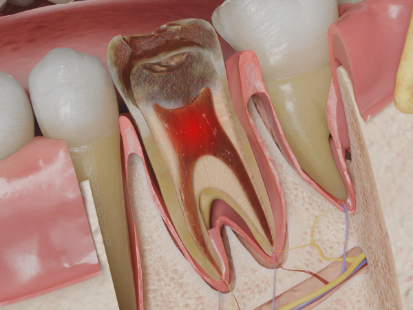 마곡역치과_4. 치수염이면 무조건 신경치료 해야 할까요? 단계별 기준 정리 관련 이미지 2