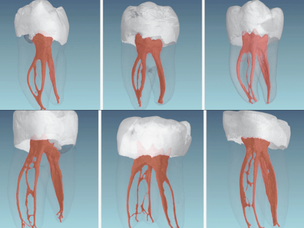 마곡치과_1. 재신경치료 필요한 이유, 신경치료 후 통증 왜 다시 아플까요? 관련 이미지 1