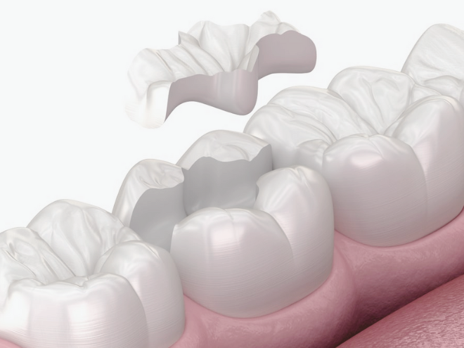 마곡동치과_4. 오래된 아말감 제거 후 치료 방법, 레진, 인레이, 크라운 언제 필요할까? 관련 이미지 3