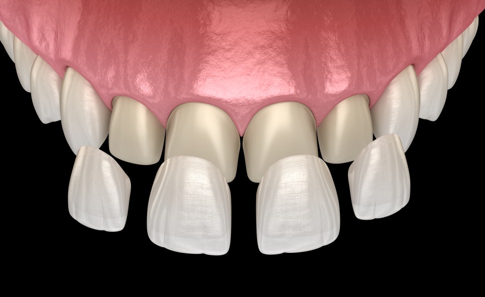[ Magok Veneers_05 ] How Long Do Veneers Last? image 1