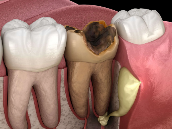 마곡동치과_"붓고 고름이 나와요" [1. 잇몸 고름 주머니 원인] 관련 이미지 3