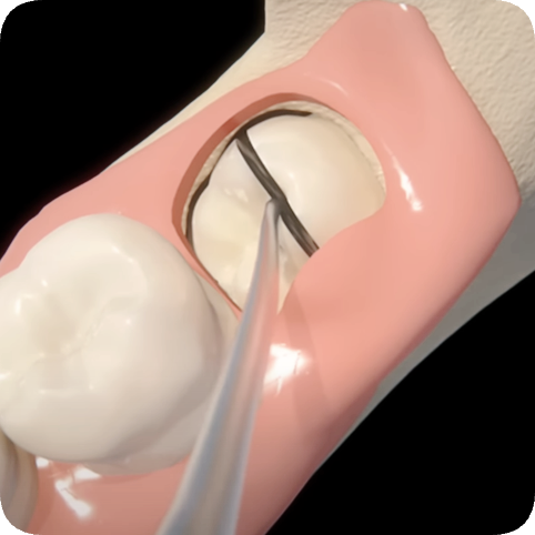 마곡역치과_4. 사랑니 발치, 어떤 과정을 거치나요? 관련 이미지 5