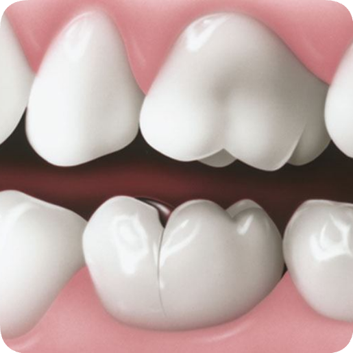 마곡동치과_ "자연치아 지키는 골든타임" [ 1. 신경치료 꼭 받아야 하는 5가지 경우 ] 관련 이미지 3