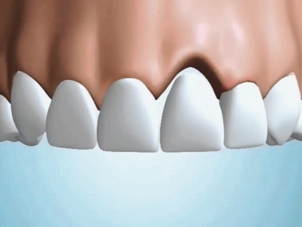 [ 마곡동치과_치아 상실 4 ] 브릿지 치료, 빠르게 해결 가능하지만 괜찮을까요? 관련 이미지 4