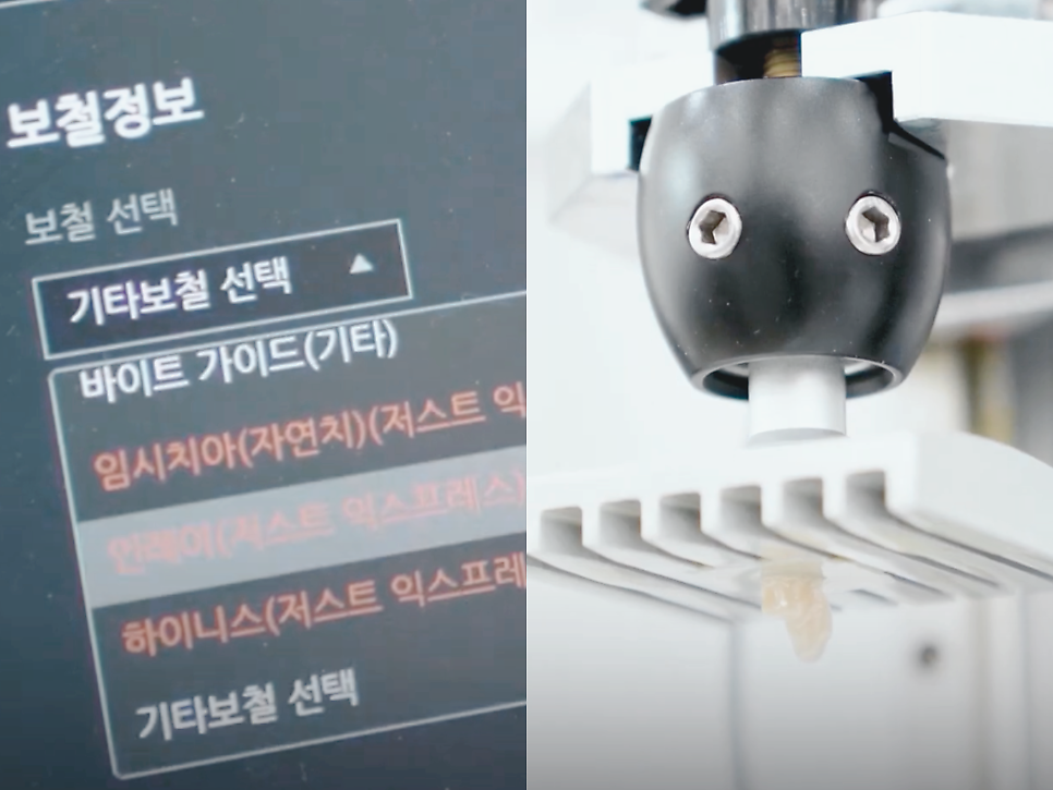 마곡동치과_3. 인레이 치료 과정과 소요 시간 (feat. 저스트 스캔) 관련 이미지 6