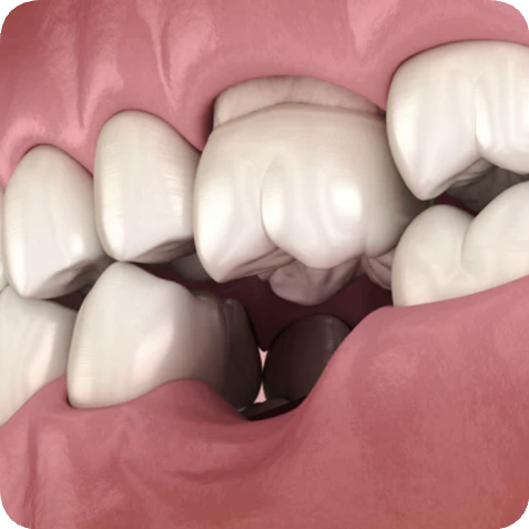 마곡역치과_ 충치, 풍치, 외상으로 치아 빠졌다면? [ 2. 임플란트가 필요한 경우 ] 관련 이미지 5