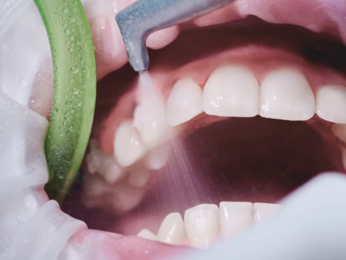 마곡역치과_ &ldquo;참지 말고 잡자!&rdquo; [ 2. 시린이(지각과민증) 치료 ] 관련 이미지 4