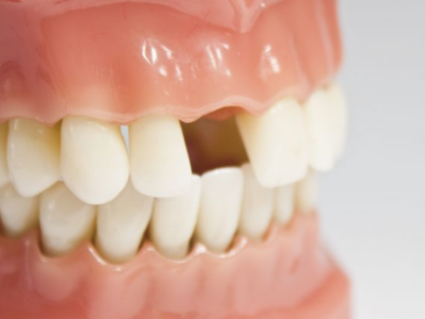 마곡동치과_ &ldquo;이럴 때 치아 본을 떠야 합니다!&rdquo; [2. 인상채득이 필요한 경우] 관련 이미지 2