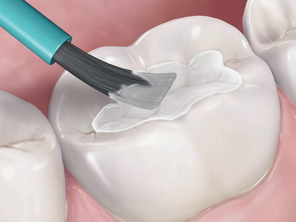 Maggok Station Dental Clinic_“Prevent Cavities Before They Start” [1. What Is Pit and Fissure Sealant?] image 5