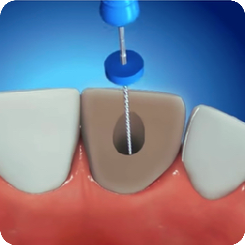 마곡역치과_ &ldquo;죽은 치아도 다시 하얘진다!&rdquo; [4. 실활치 미백치료 특징과 과정] 관련 이미지 4