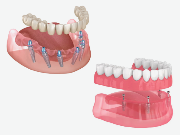 마곡동치과_ &ldquo;틀니와 임플란트의 만남&rdquo; [ 1.임플란트 틀니란? ] 관련 이미지 4