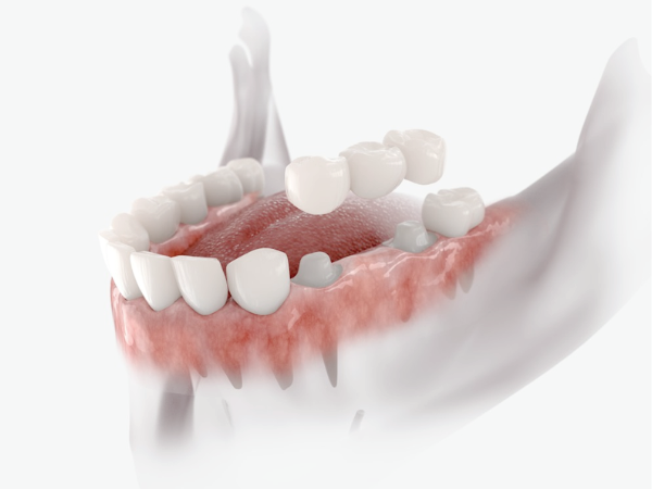 마곡동치과_1. 브릿지 치료란 무엇인가요? 임플란트, 틀니와 차이부터 정리합니다 관련 이미지 6