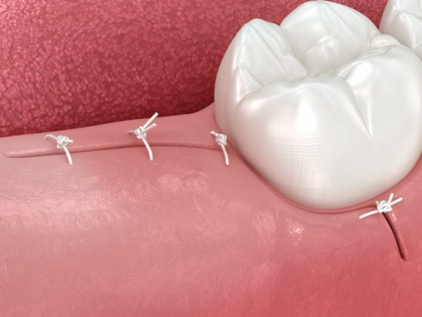 마곡역치과_6. 사랑니 발치 후 통증, 정상일까? 통증 지속 기간과 관리법 관련 이미지 4