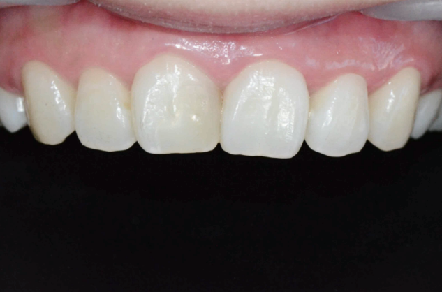 마곡동치과_4. 무삭제 라미네이트(디아네이트) 리얼 후기 3가지 케이스 관련 이미지 6