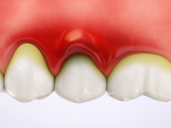마곡동치과_"붓고 고름이 나와요" [1. 잇몸 고름 주머니 원인] 관련 이미지 4