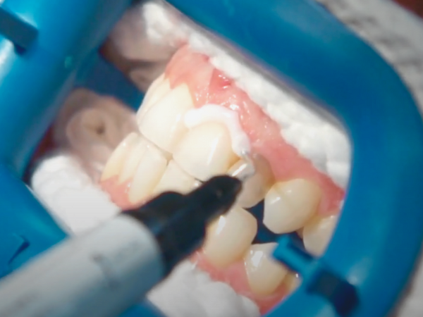 마곡치과_" 짧은 시간, 확실한 톤업" [2. 생활치 전문가 미백치료 특징과 과정 관련 이미지 4