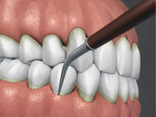 Magok Dental Clinic_5. Is Discomfort After Gum Treatment Normal? A Guide to Pain and Eating Care image 1