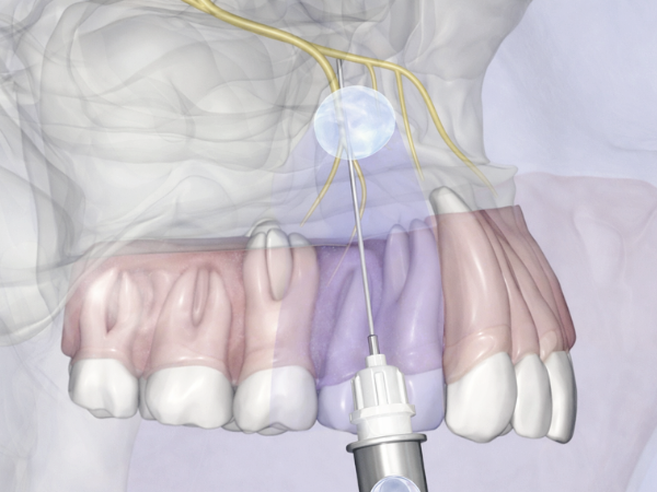 마곡동치과_1. 치과 국소마취, 종류별로 뭐가 다를까요? 관련 이미지 2