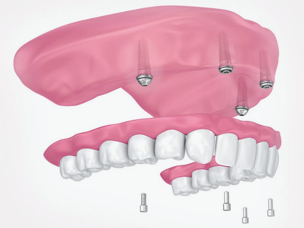 마곡동치과_ &ldquo;내 입에 딱! 맞는 선택은?&rdquo; [ 5. 임플란트 틀니 종류와 특징 ] 관련 이미지 1