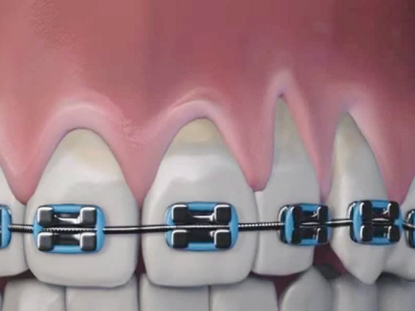 마곡동치과_&ldquo;내려간 잇몸, 더 내려가지 않게 하려면?&rdquo; [4. 치은퇴축 생활 관리법] 관련 이미지 5