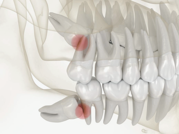 마곡동치과_2.사랑니 방치하면 어떻게 될까? 발치가 필요한 진짜 이유 4가지 관련 이미지 3