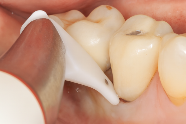 마곡치과_"긁지 말고, 부드럽게 관리!" [ 2. 임플란트 전용 에어플로우 스케일링 ] 관련 이미지 5