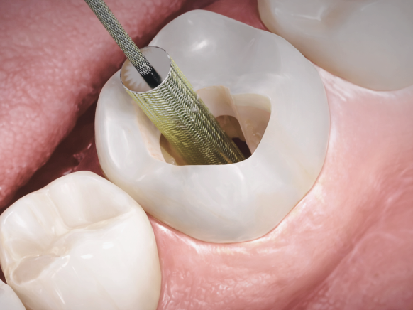 마곡치과_3. 재신경치료 과정, 신경치료 후 다시 아플 때 어떻게 진행될까요? 관련 이미지 1
