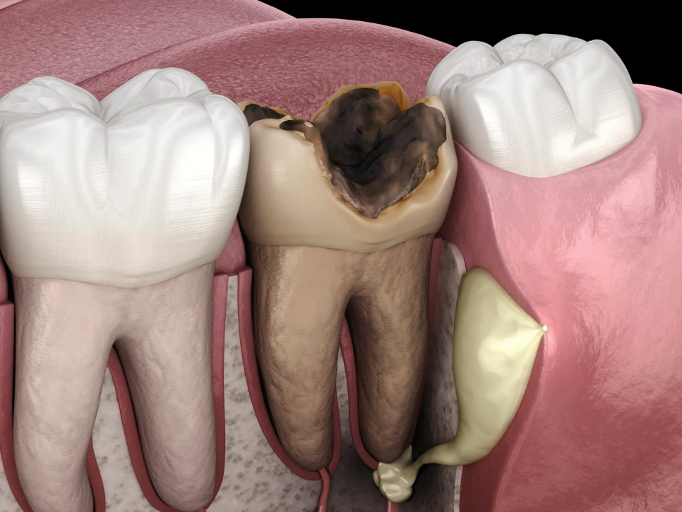 마곡동치과_ "이를 뽑은 날 바로 심을 수 있을까" [ 1. 당일 임플란트 조건 ] 관련 이미지 3