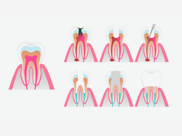 마곡역치과_2. 신경치료 후 통증, 참아도 될 때 vs 꼭 확인해야 할 때 관련 이미지 8