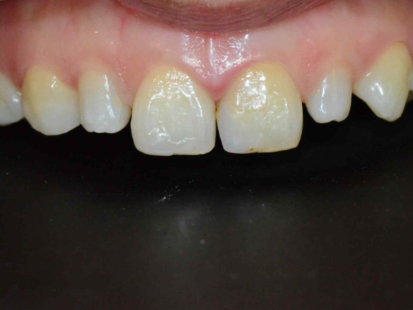 마곡역치과_4. 왜소치, 디아네이트 무삭제 라미네이트 케이스 관련 이미지 5