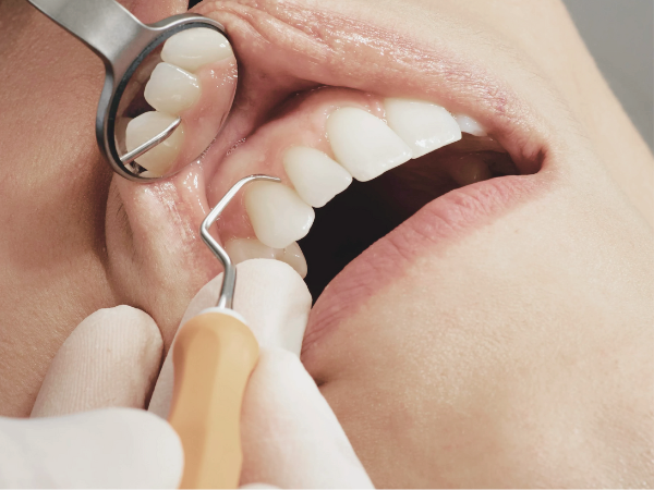 마곡동치과_ &ldquo;치아본 제대로 뜨려면?&rdquo; [4. 인상채득 시 주의할 점] 관련 이미지 1