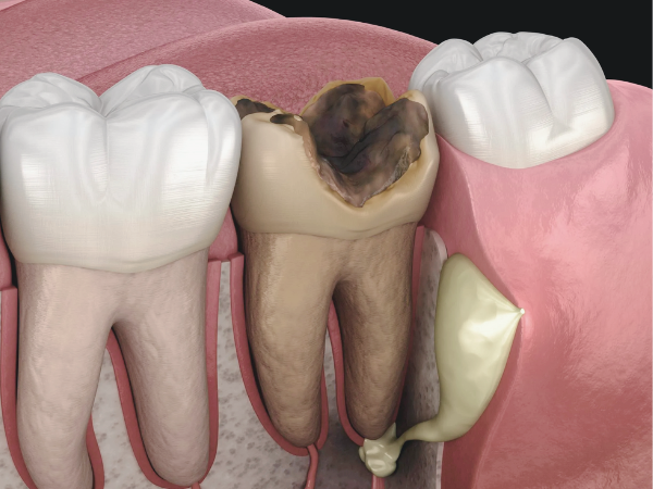 마곡동치과_1. 임플란트 치료에 관련 이미지 5