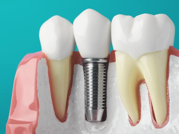 마곡동치과_3. 기초부터 튼튼하게, 뼈이식 임플란트 진행 과정 관련 이미지 1