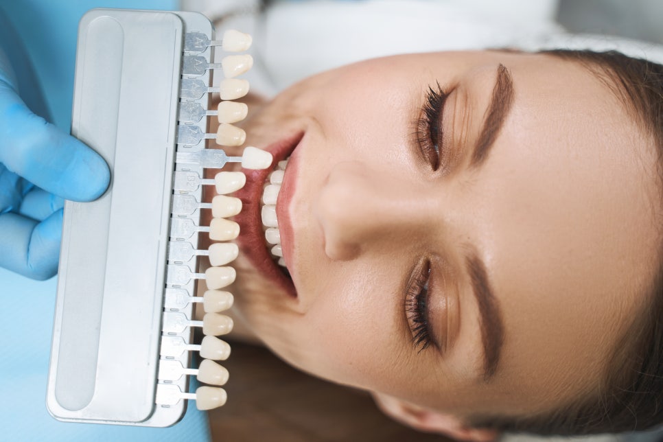 [Magok Veneers_01] What Are Veneers? The Thin Porcelain Pieces Attached to Teeth image 2
