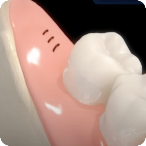 마곡역치과_4. 사랑니 발치, 어떤 과정을 거치나요? 관련 이미지 8