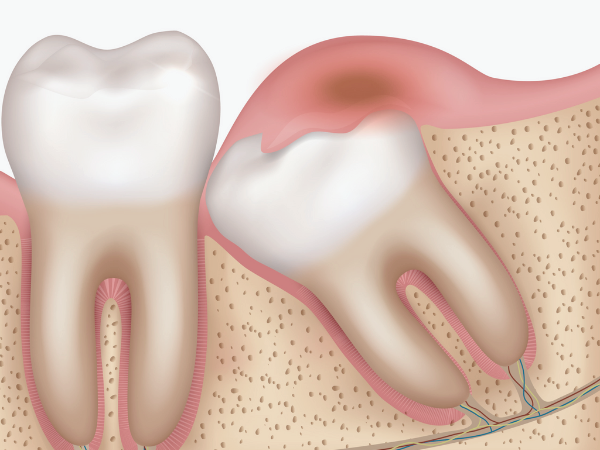 마곡역치과_3. 사랑니 염증 반복되는 이유, 치료해도 다시 불편해질까요? 관련 이미지 4